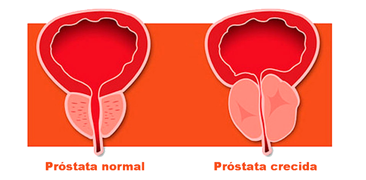 Próstata