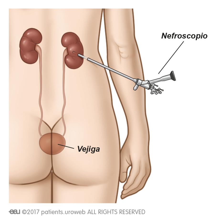 Enfermedades de ¿nefrolitotomía percutánea?